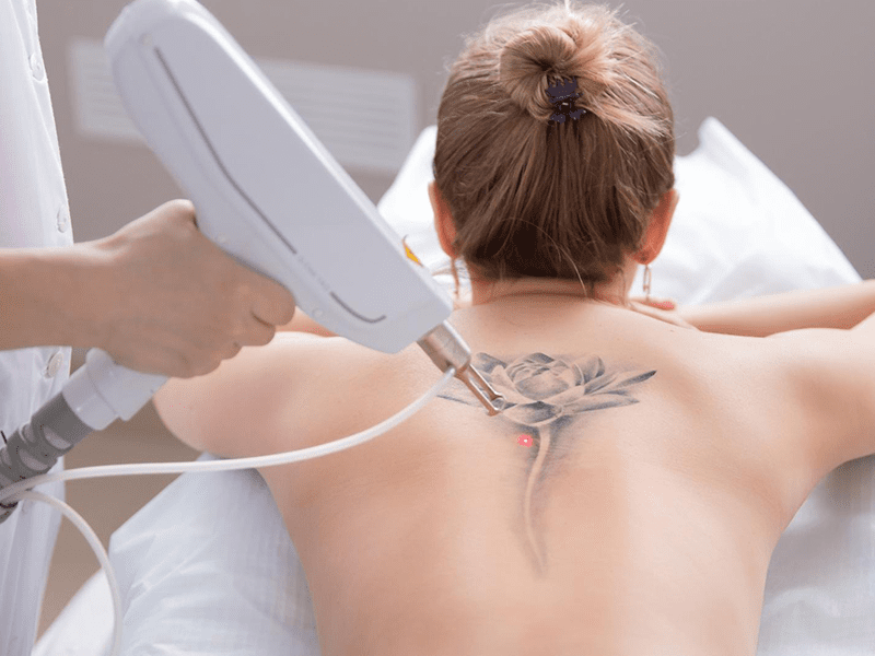 Tattoo removal by Nu U Skin Specialist